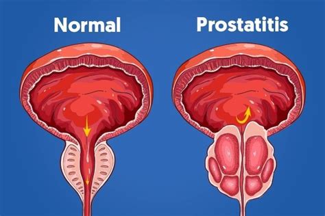 durere la ejaculare|Prostatita (Inflamația prostatei ): Cauze, simptome ...